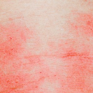 Article - Eczema Skin Article - Eczema Skin
