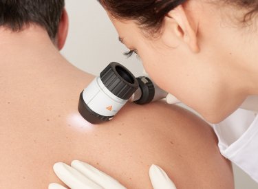 Peau atopique Peau atopique